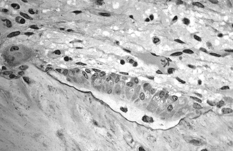 active osteoblasts
