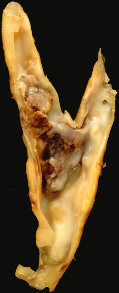 carotid plaque